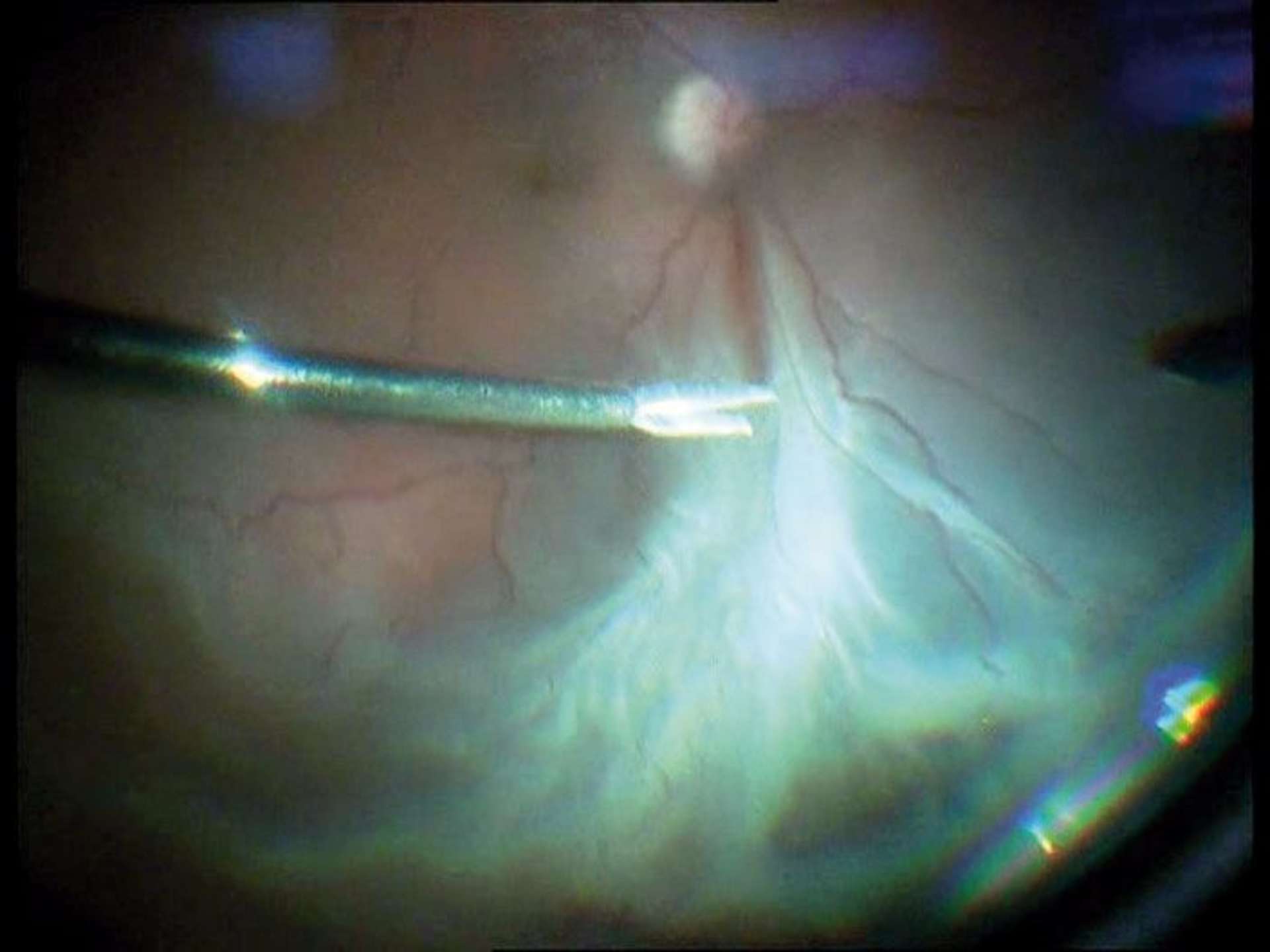 DR avec PVR postérieure et antérieure : dissection à la pince de toute la prolifération postérieure.
