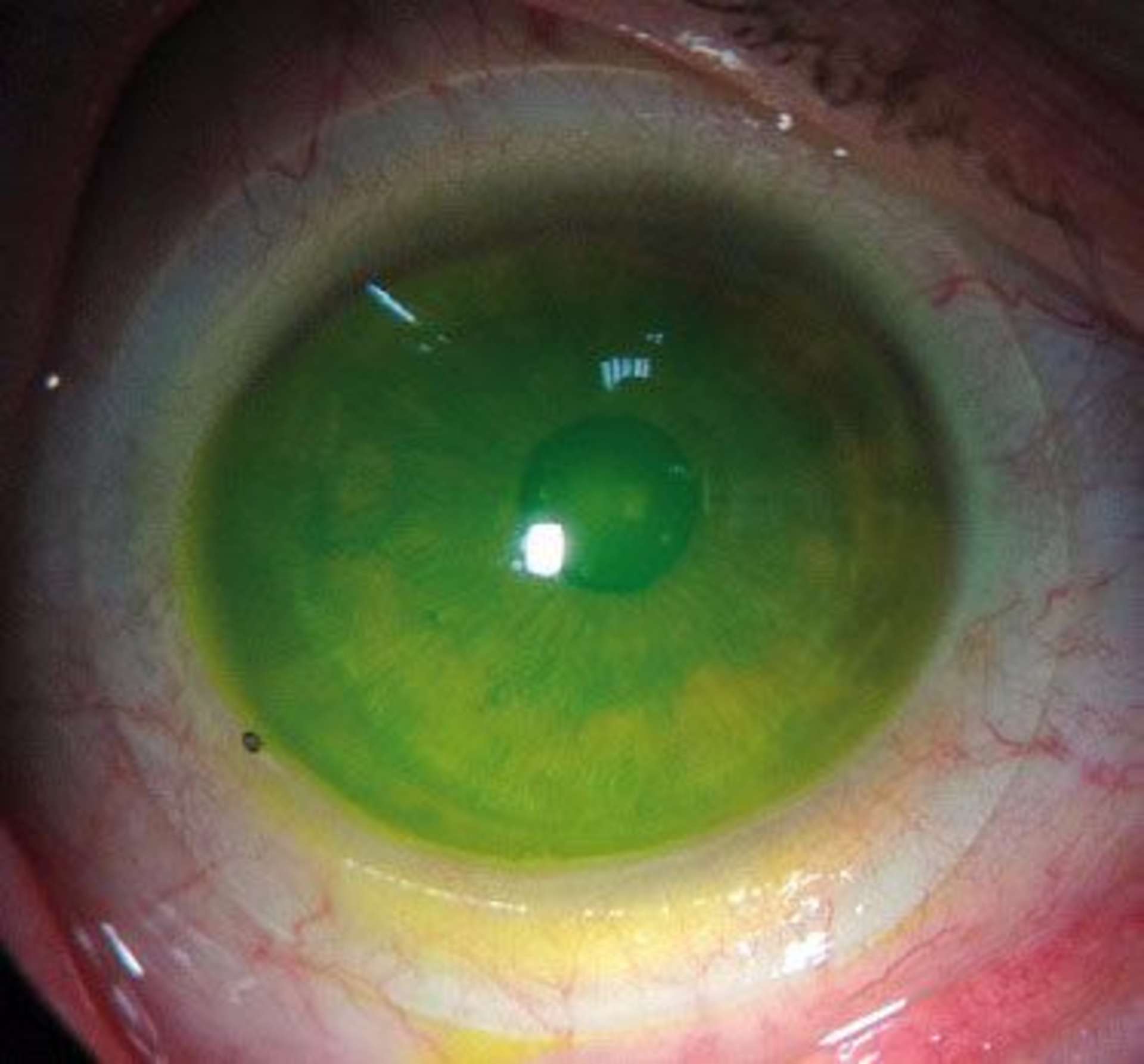 Figure 4. Lentille sclérale ICD HD 4 600 sur l’œil gauche.

