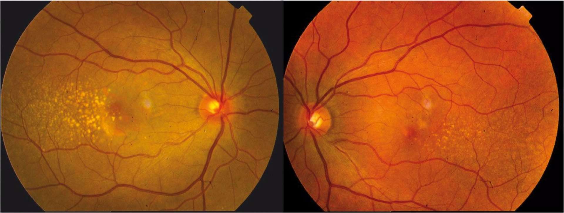 Rétinophotographie montrant la présence de très nombreuses lésions blanc-jaune, arrondies, de petite taille regroupées en temporal maculaire.
