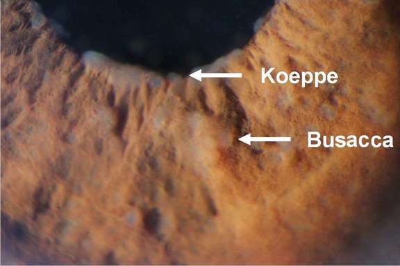 Nodules iriens de Koeppe (bord pupillaire) et de Busacca (stroma irien)
