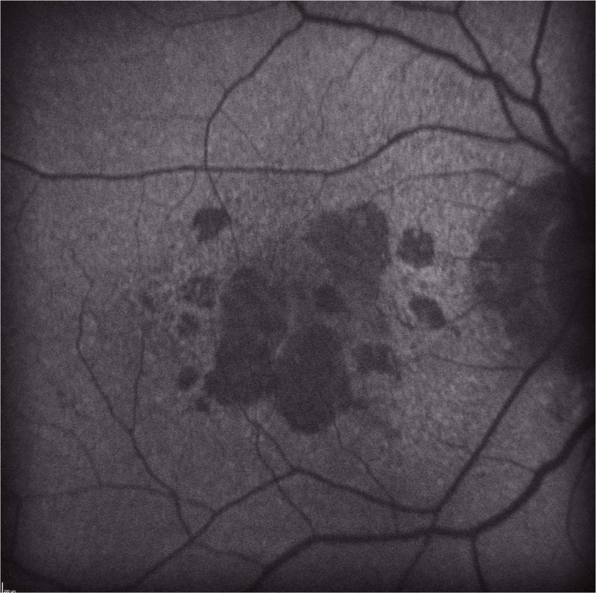 Image en autofluorescence centrée sur la macula. On voit l’hypoautofluorescence physiologique des vaisseaux rétiniens et de la papille. En revanche, on distingue l’hypoautofluorescence pathologique des zones d’atrophie maculaire et péripapillaire.
