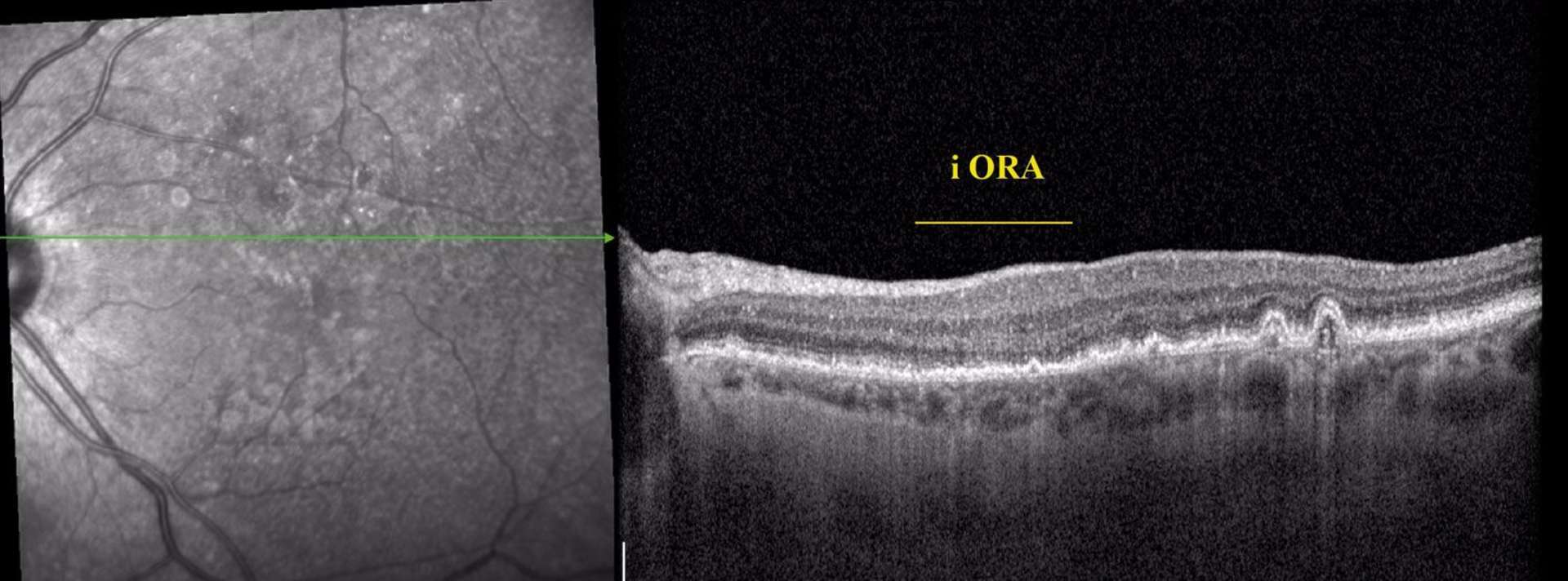 Figure 4. SD-OCT d’une atrophie géographique de type i-ORA.
