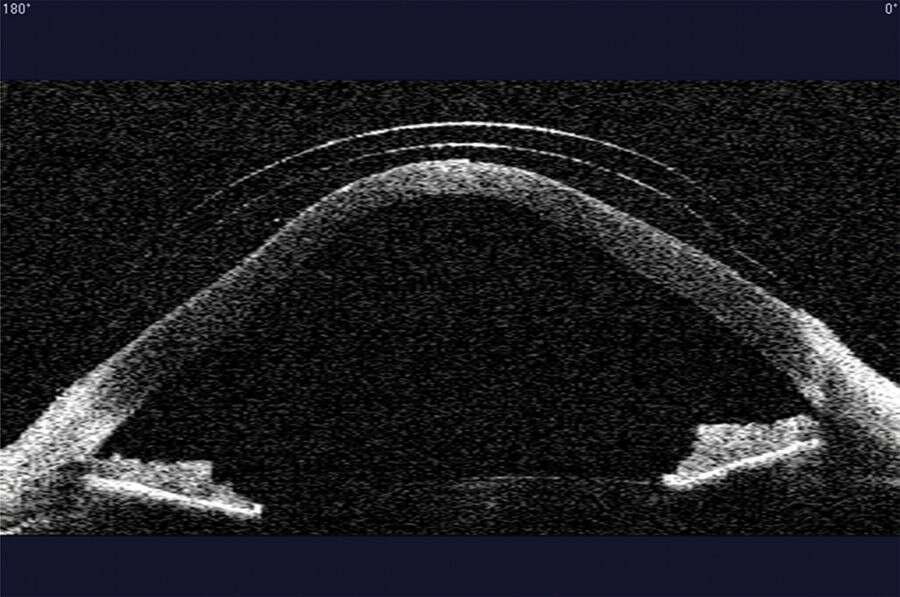 Figure 2. OCT Visante cornéen de l’œil droit :&nbsp;importante déformation cornéenne.
