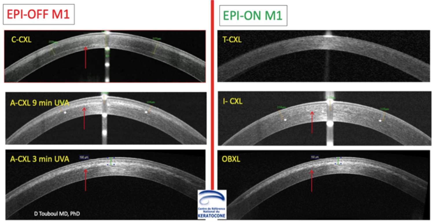 Figure 2. Comparaison des différentes profondeurs d’interactions dans le stroma cornéen par analyse de la réflectivité cornéenne en OCT-SD. Protocoles EPI-OFF à gauche : C pour conventionnel, A pour accéléré ; EPI-ON à droite : T pour transépithélial avec perméabilisants collyres seuls, I pour iontophorèse, OB pour « Oxygen Boosted ». Les flèches pointent la profondeur des lignes de démarcations observées (images David Touboul).
