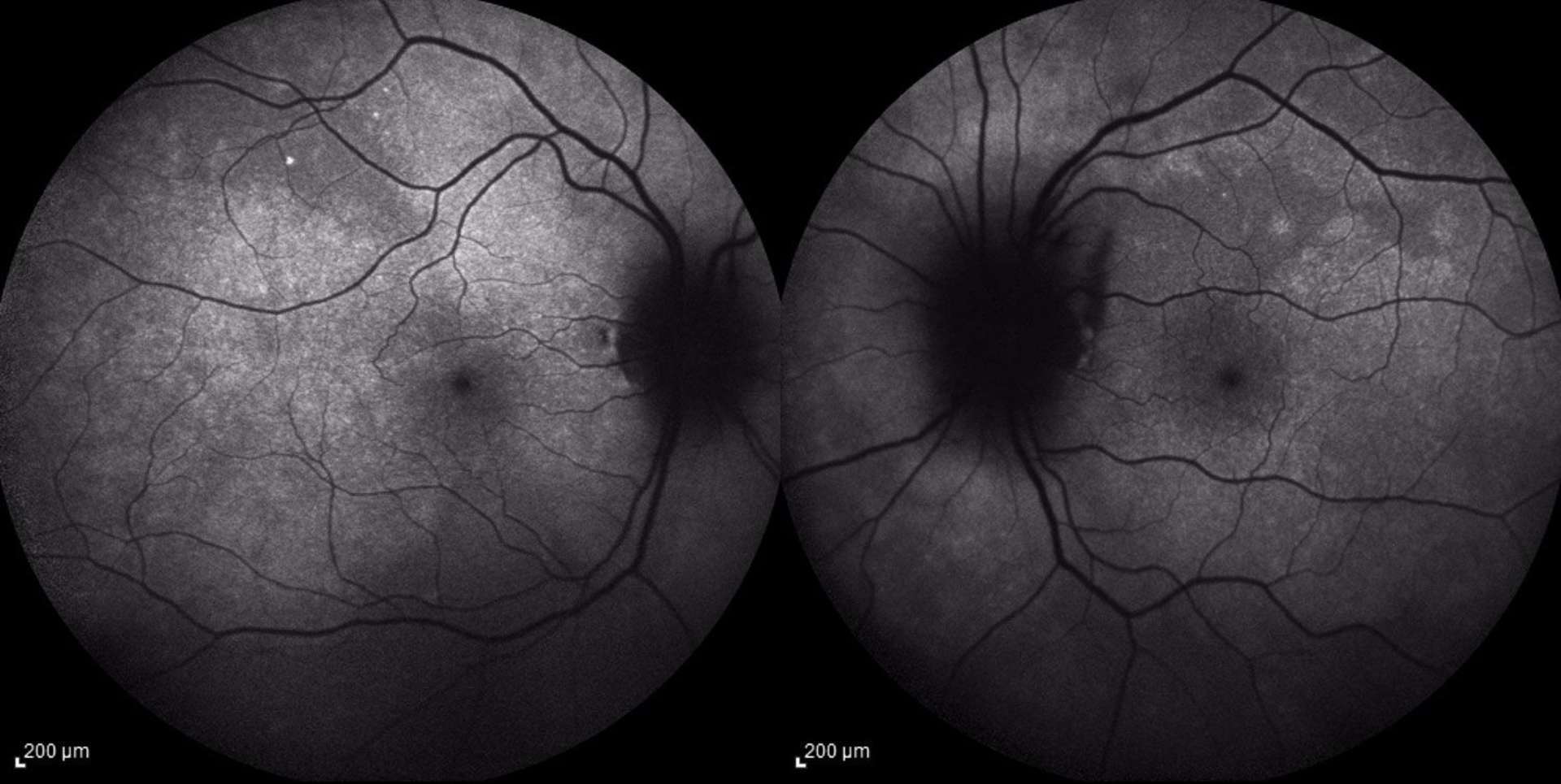 Figure 3. Cliché autofluorescent au diagnostic.
