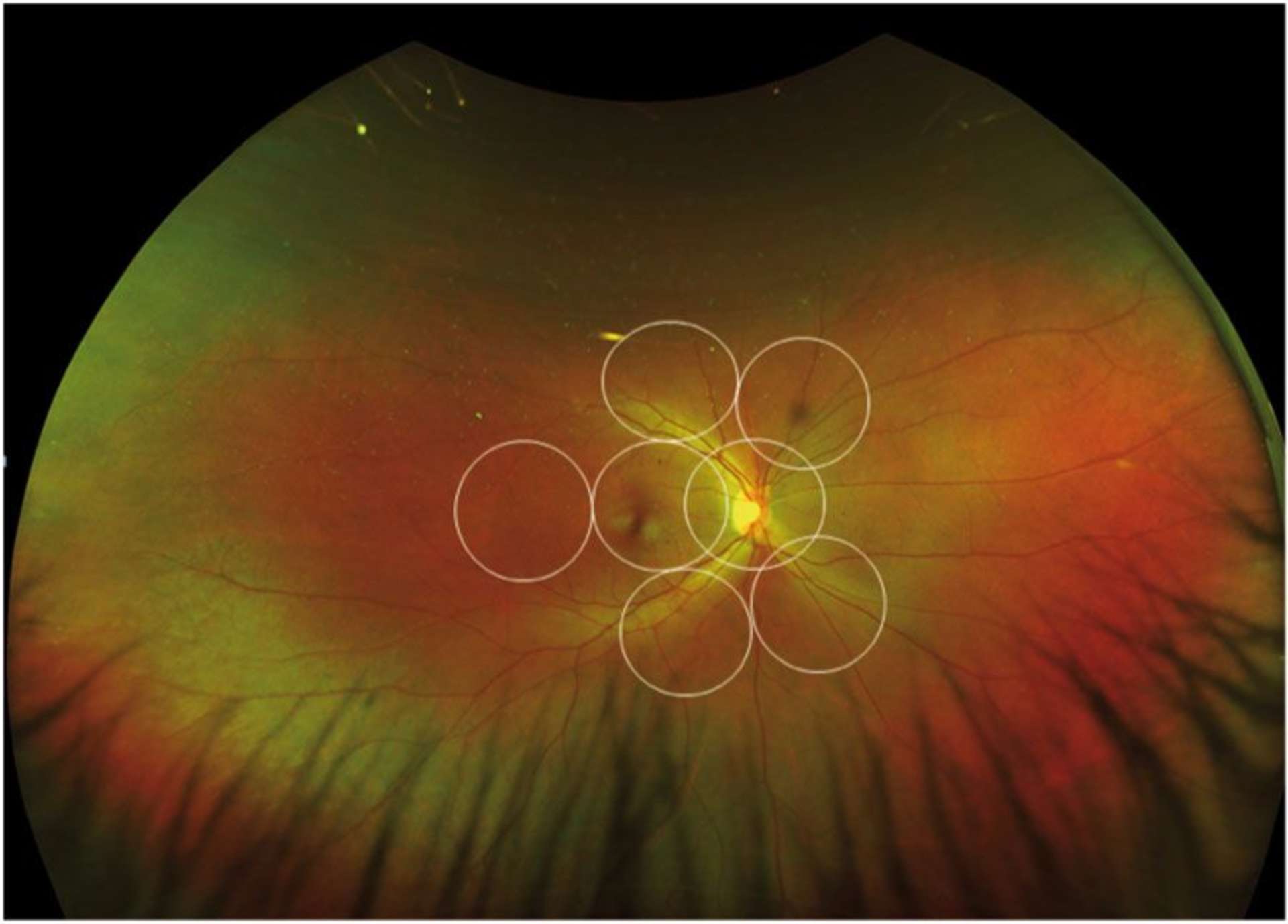 Figure 1. Projection de montage de clichés selon le protocole 7SF (cercles blancs) sur un cliché de rétinophotographies UGC (Optos) rend compte du territoire rétinien.
