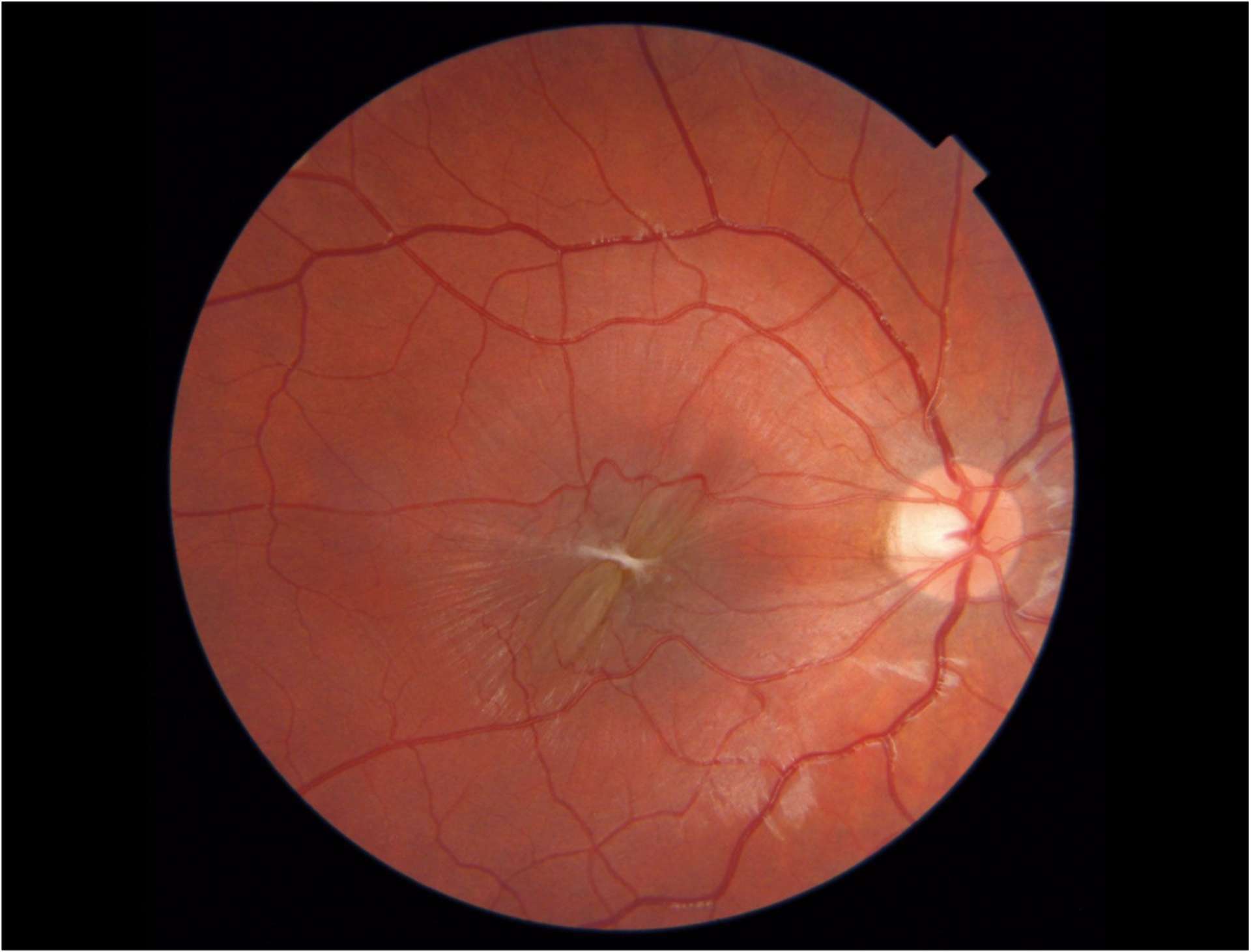 Figure 1. A. Patiente de 7 ans présentant une membrane idiopathique. Aspect en rétinophoto en préopératoire.
