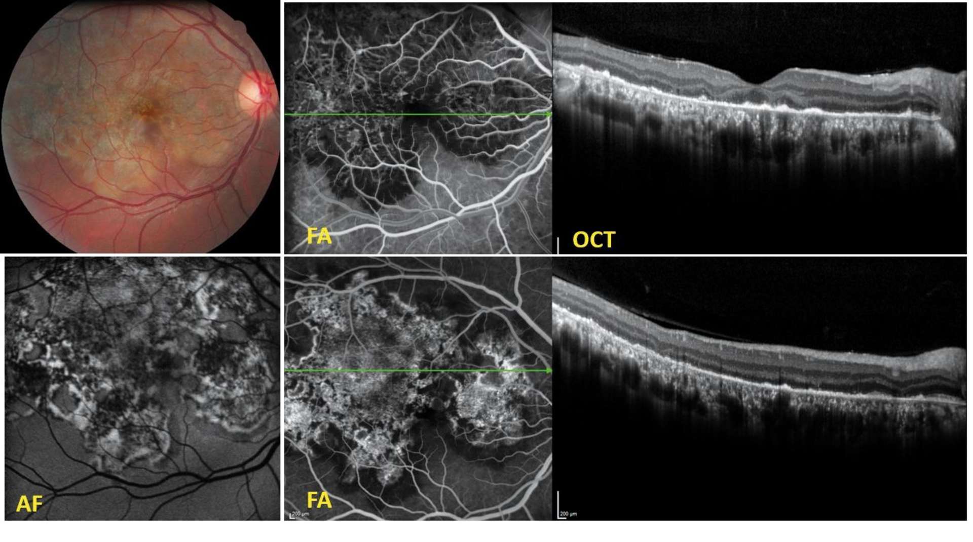 Figure 4. Large lésion de choroïdite multifocale serpigineuse tuberculeuse avec des bords actifs en temporal inférieur, cicatriciels au pôle postérieur et en temporal supérieur et une extension géographique ; en angiographie à la fluorescéine (FA) : le bord de la vaste lésion est hypo­fluorescent dans sa partie active (en temporal inférieur) aux temps précoces et hyperfluorescent aux temps tardifs ; en autofluorescence (AF) : aspect d’hyperautofluorescence diffuse, aspect hétérogène ; coupe maculaire en Spectral-Domain OCT (Heidelberg Spectralis®) montrant des modifications de la couche des photorécepteurs et de l’épithélium pigmentaire.
