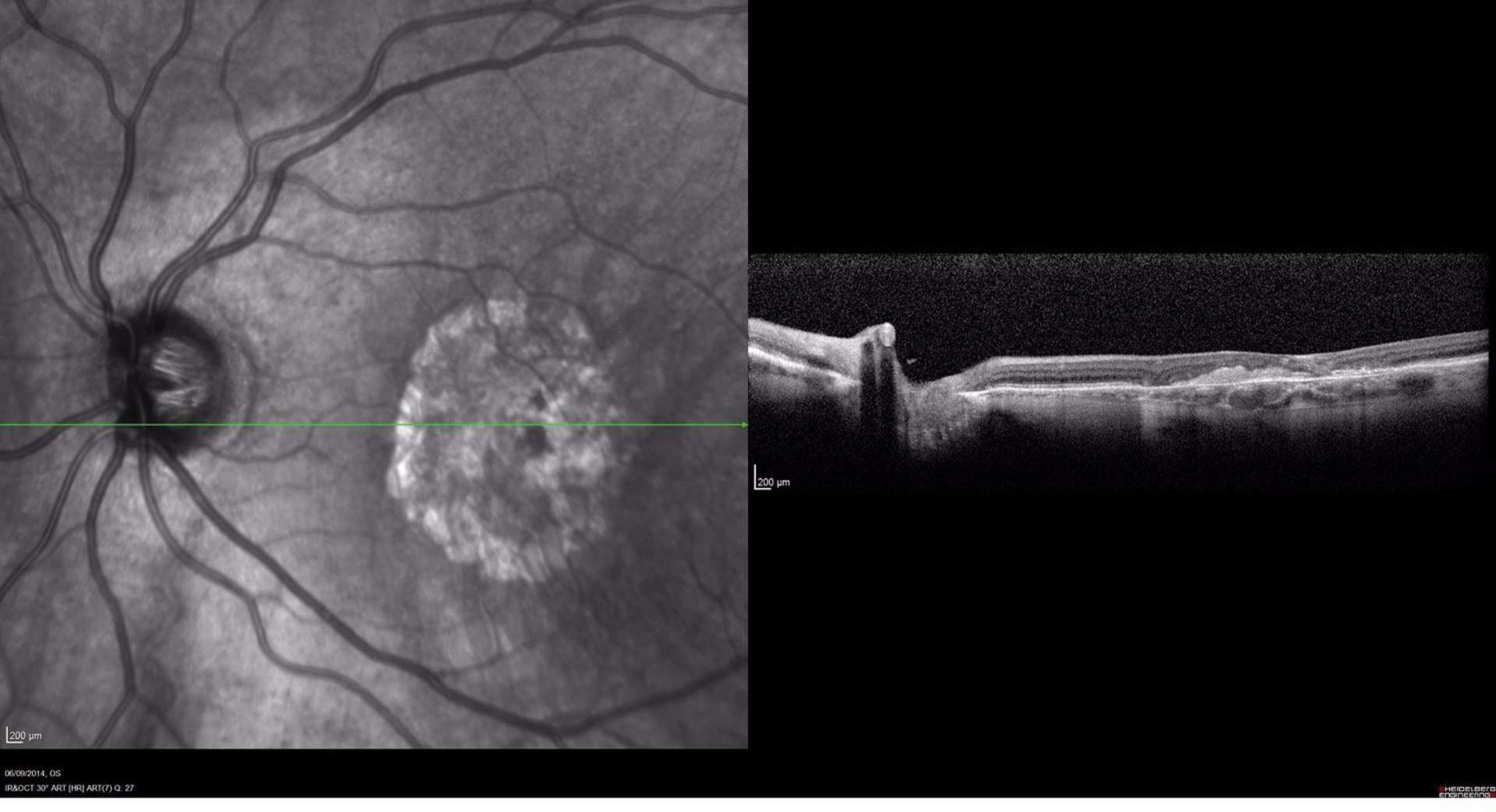 Atrophie fibrogliale sévère pré-épithéliale de la région maculaire
