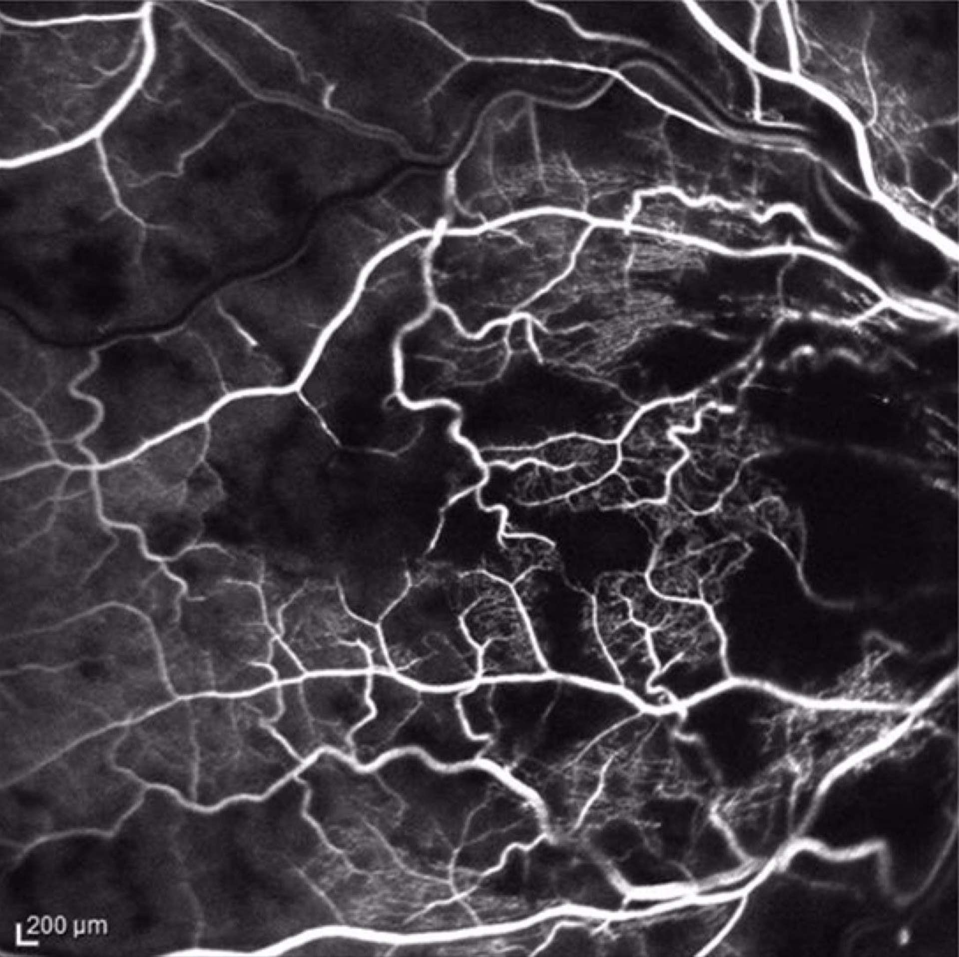 Angiographie à la fluorescéine. OVCR avec présence de plages d’ischémie au pôle postérieur. La zone avasculaire centrale est encochée et irrégulière.
