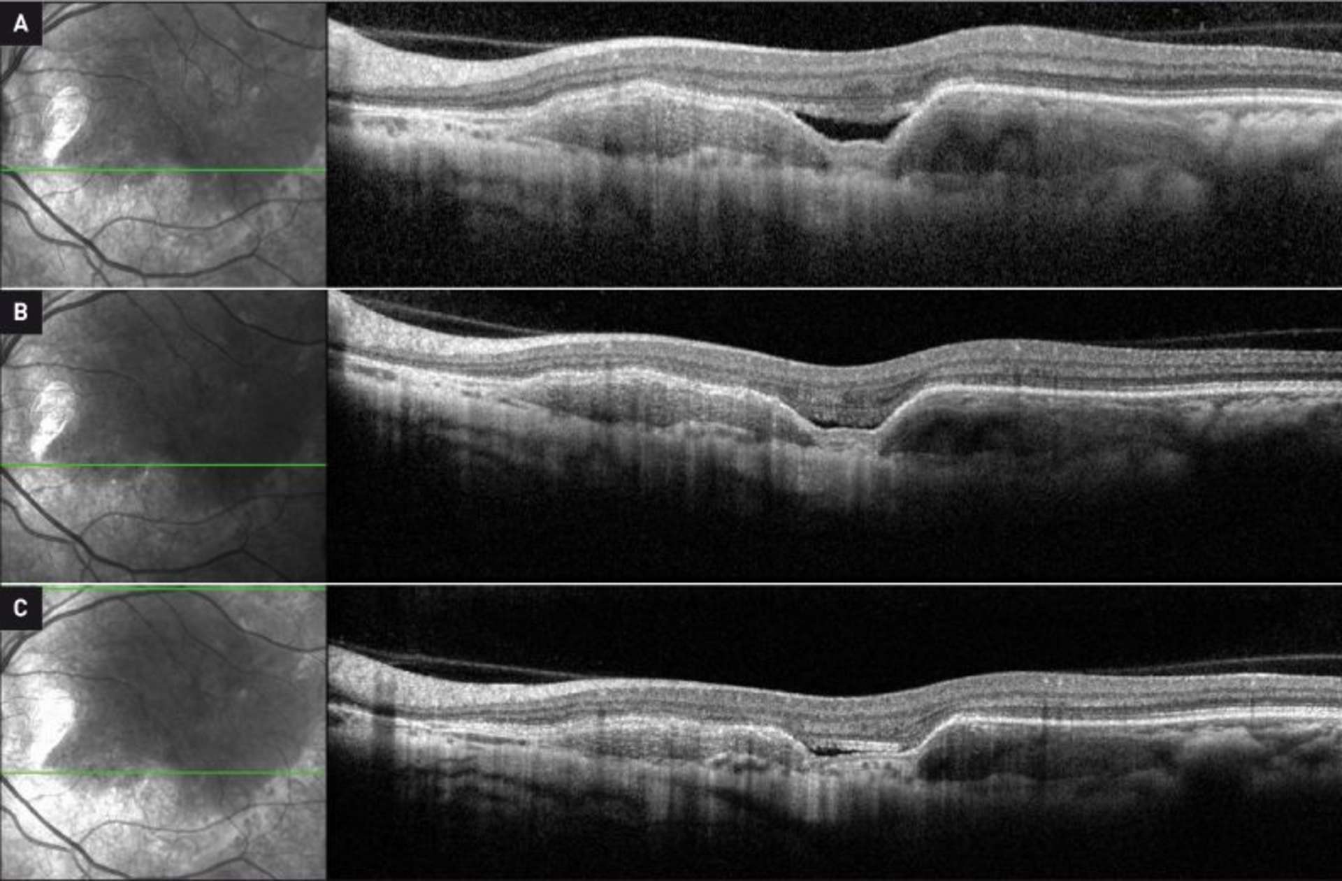 Figure 4. Fluctuations spontanées du DSR secondaire à l’exsudation tumorale en absence d’injections intravitréennes : 3 mois (A), 5 mois (B), 6 mois (C) après l’arrêt du traitement.
