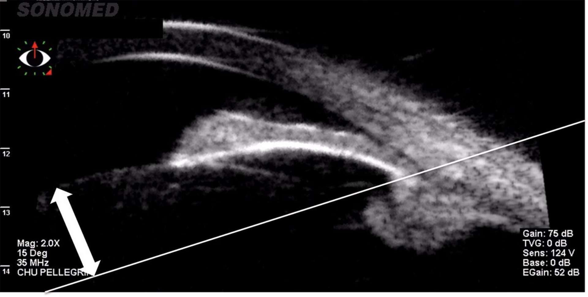 Figure 3. Phakomorphisme en UBM (sonde 35 MHz, VUmax, Sonomed, New York). La flèche cristallinienne (distance entre la cristalloïde antérieure et la ligne passant par les éperons scléraux, ici représentée par la double flèche) est très augmentée. La chambre antérieure est de profondeur diminuée. L’AIC est fermé par blocage pupillaire.
