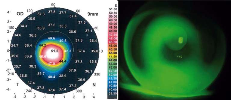 Figure 2. La topographie d’élévation (Galilei, Ziemer) montre un nipple cone. L’apex (image sombre) est au centre de la zone optique postérieure, entouré par un lac de fluorescéine (lentille Rose K2, Menicon).
