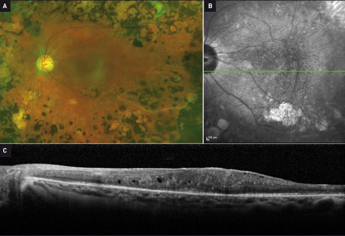 Figure 3. Évolution de l’œdème maculaire central de l’œil gauche la deuxième année&nbsp;de traitement. A. Rétinophographie couleur ultra-grand champ de l’œil gauche montrant une augmentation de la membrane épirétinienne. B. Cliché en infrarouge mettant&nbsp;en évidence des plis rétiniens secondaires à la contraction de la membrane épirétinienne. C. OCT B-scan maculaire réalisé 2 mois après le troisième implant de dexaméthasone&nbsp;et retrouvant la présence de cette membrane épirétinienne épaissie et contractile, associée à la persistance de logettes intrarétiniennes.
