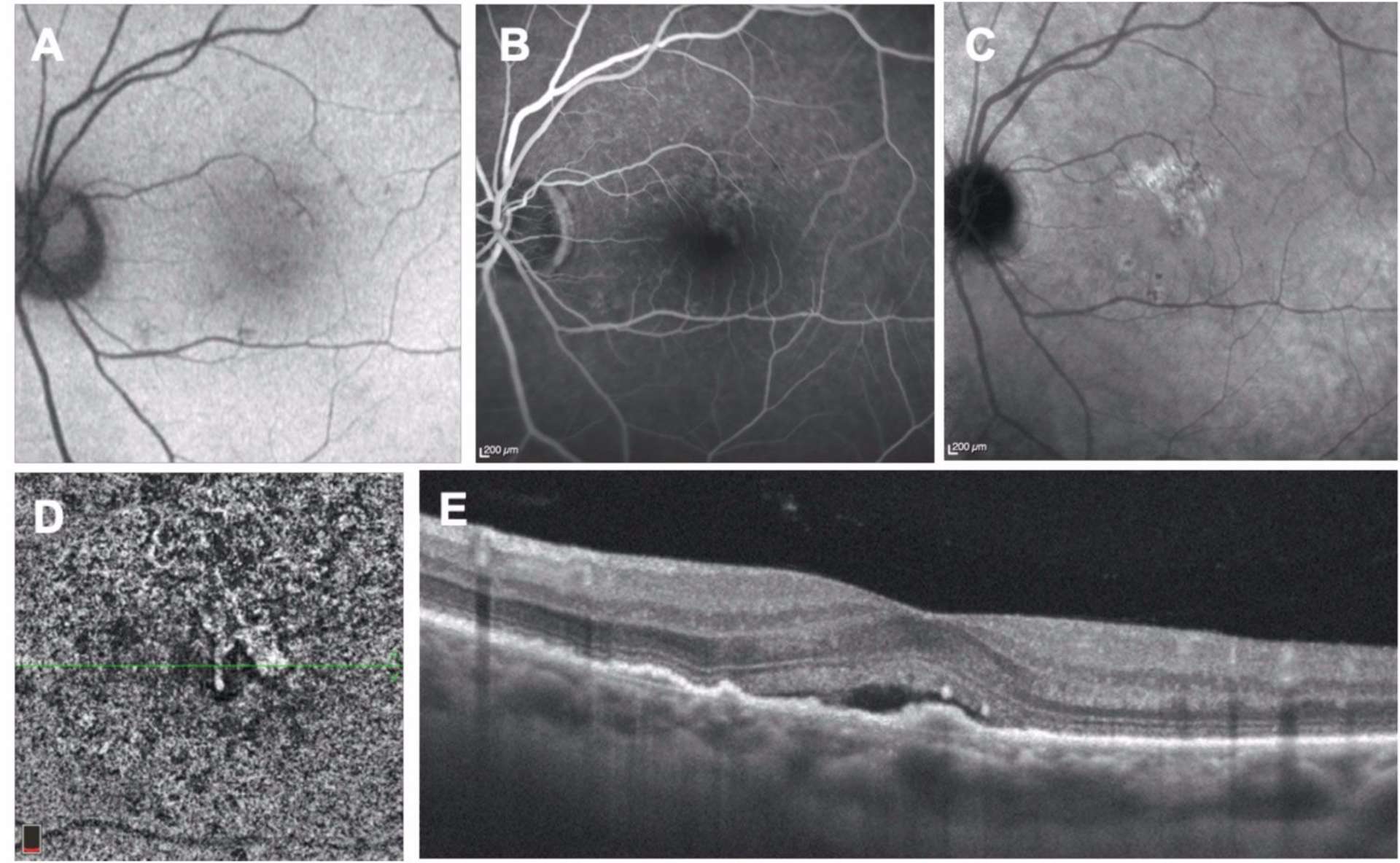 Figure 1. A. Le cliché en autofluorescence ne montre pas de dépôt hyper-autofluorecent. B. En angiographie à la fluorescéine, on visualise une hyperfluorescence mal définie en supérofovéolaire. C. En ICG, la plaque hyperfluorescente apparaît aux temps tardifs. D. Le lacis néovasculaire est visible en OCT-A dans la segmentation choriocapillaire. E. Sur la coupe OCT-SD, on visualise un DSR rétrofovéolaire avec une irrégularité de l’EP.
