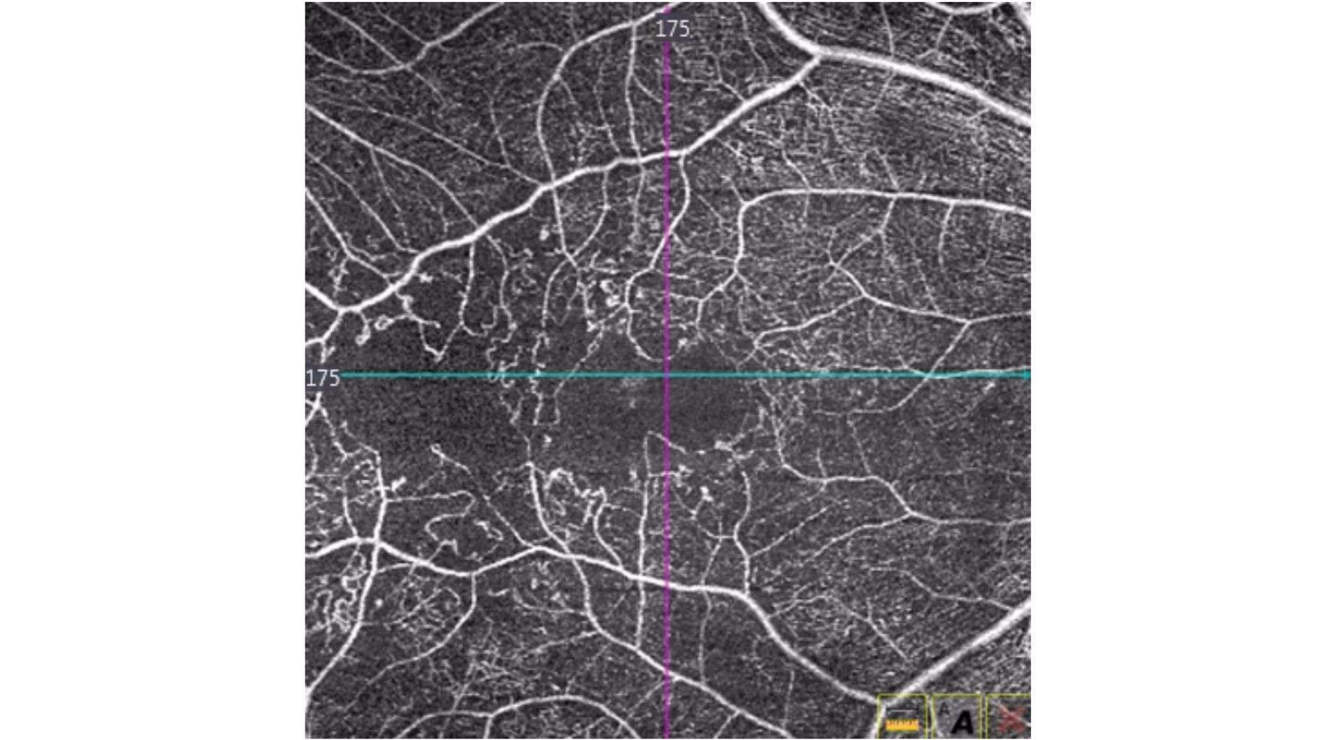 Figure 4. OCT-A correspondant avec altération de la maille capillaire périfovéolaire, diminution de la densité capillaire et zones de non-perfusion du plexus superficiel.
