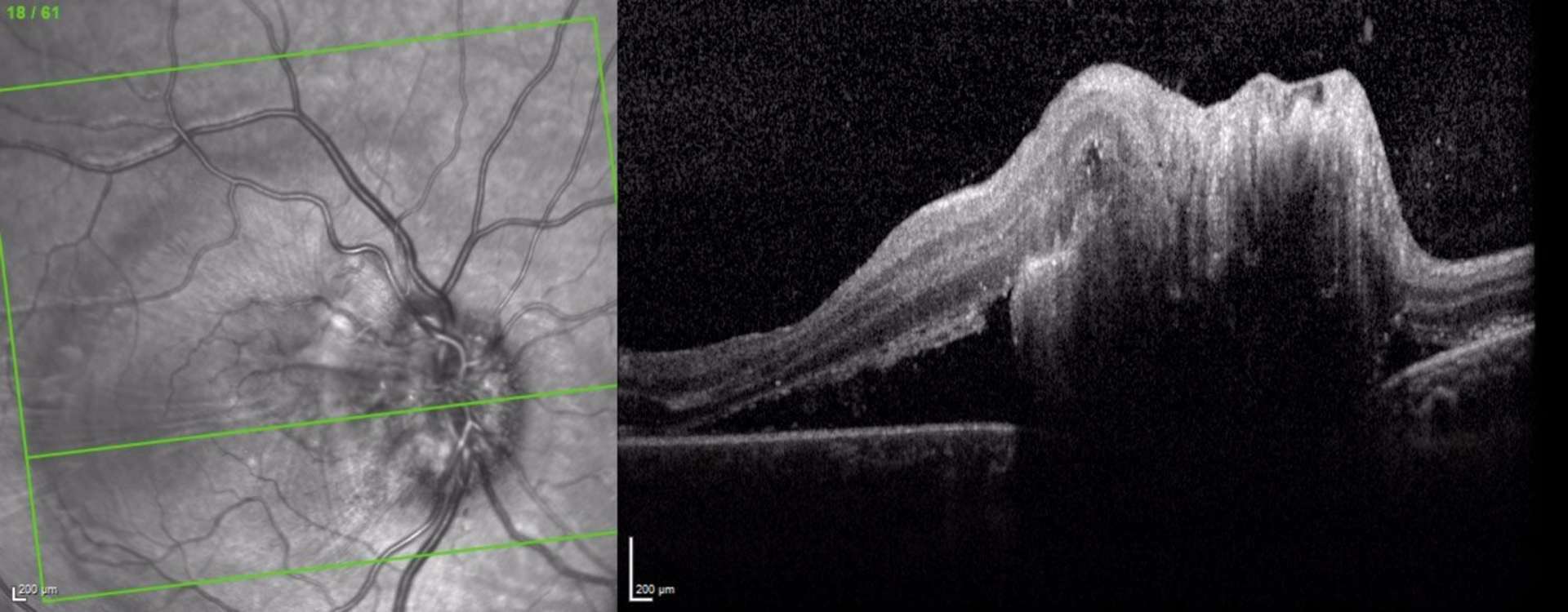 OCT, coupe transversale papillomaculaire, œil droit : œdème papillaire. Aspect de cavitation hyporéflective dans la tête saillante du nerf optique, effet masque postérieur. Décollement séreux rétinien soulevant la fovéola.
