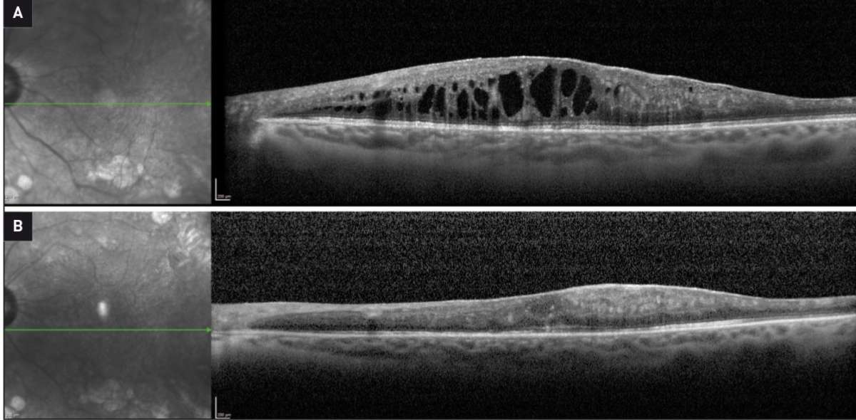 Figure 2. OCT B-scan maculaires montrant l’évolution de l’œdème maculaire de l’œil gauche sous traitement. A. OCT B-scan maculaire réalisé 1 mois après 3 injections intravitréennes d’anti-VEGF. Il persiste de nombreuses logettes intrarétiniennes et l’épaisseur maculaire centrale est mesurée à 682 microns. B. OCT B-scan maculaire réalisé 2 mois après une injection intravitréenne d’implant de dexaméthasone. On note une régression quasi complète des logettes intrarétiniennes. Il persiste une logette centrale et un épaississement localisé en rapport avec la présence de la membrane épirétinienne. L’épaisseur maculaire centrale est mesurée à 334 microns.

