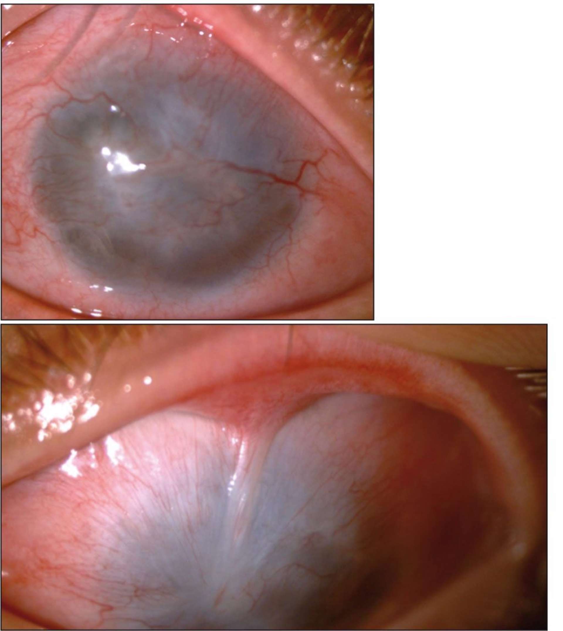 Figure 4. Insuffisance limbique sur 360 degrés entraînant une conjonctivalisation cornéenne avec brides conjonctivales suite à une brûlure basique.
