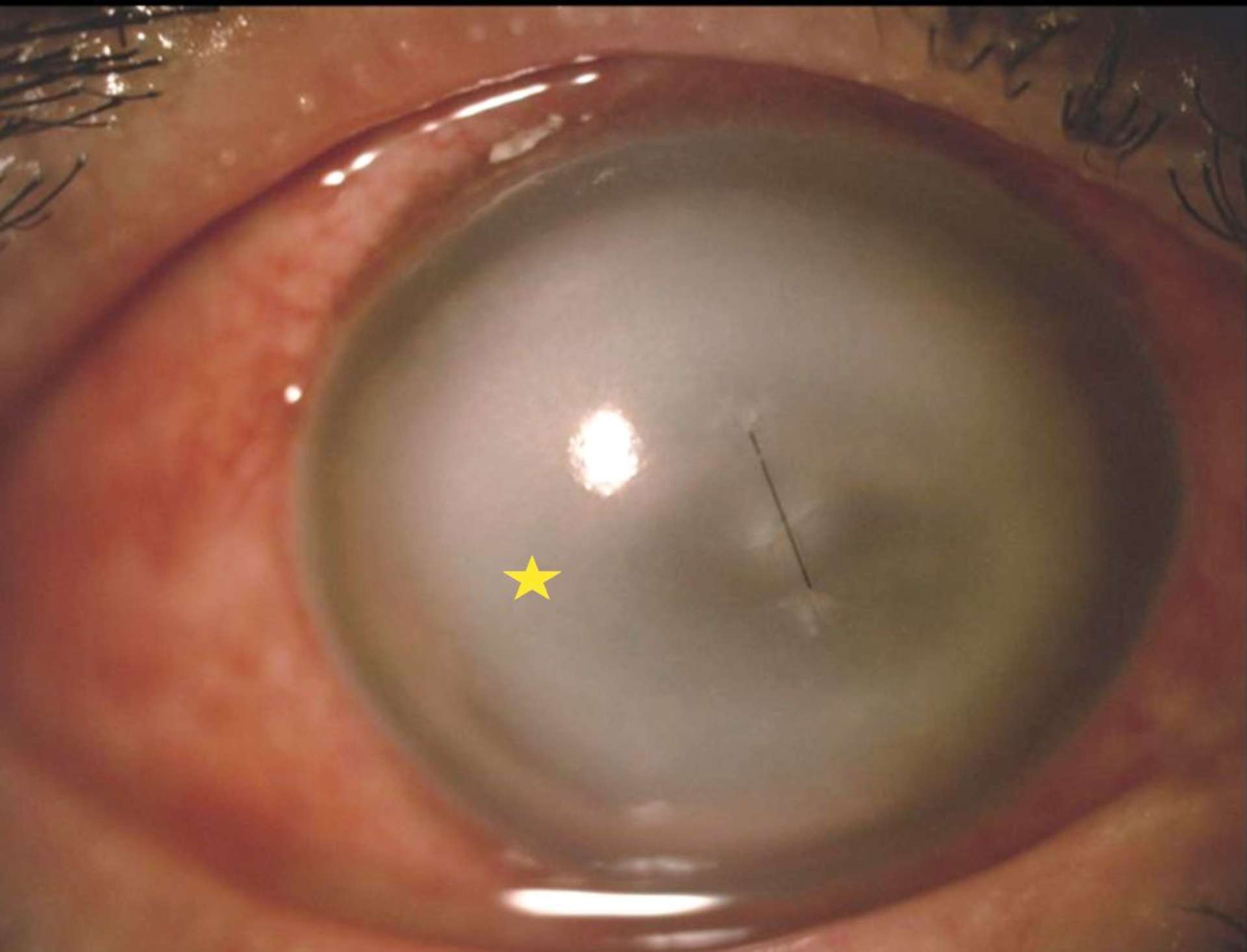 Figure 3. Endophtalmie post-traumatique. Noter l’infiltrat cornéen annulaire caractéristique du Bacillus cereus (étoile jaune).
