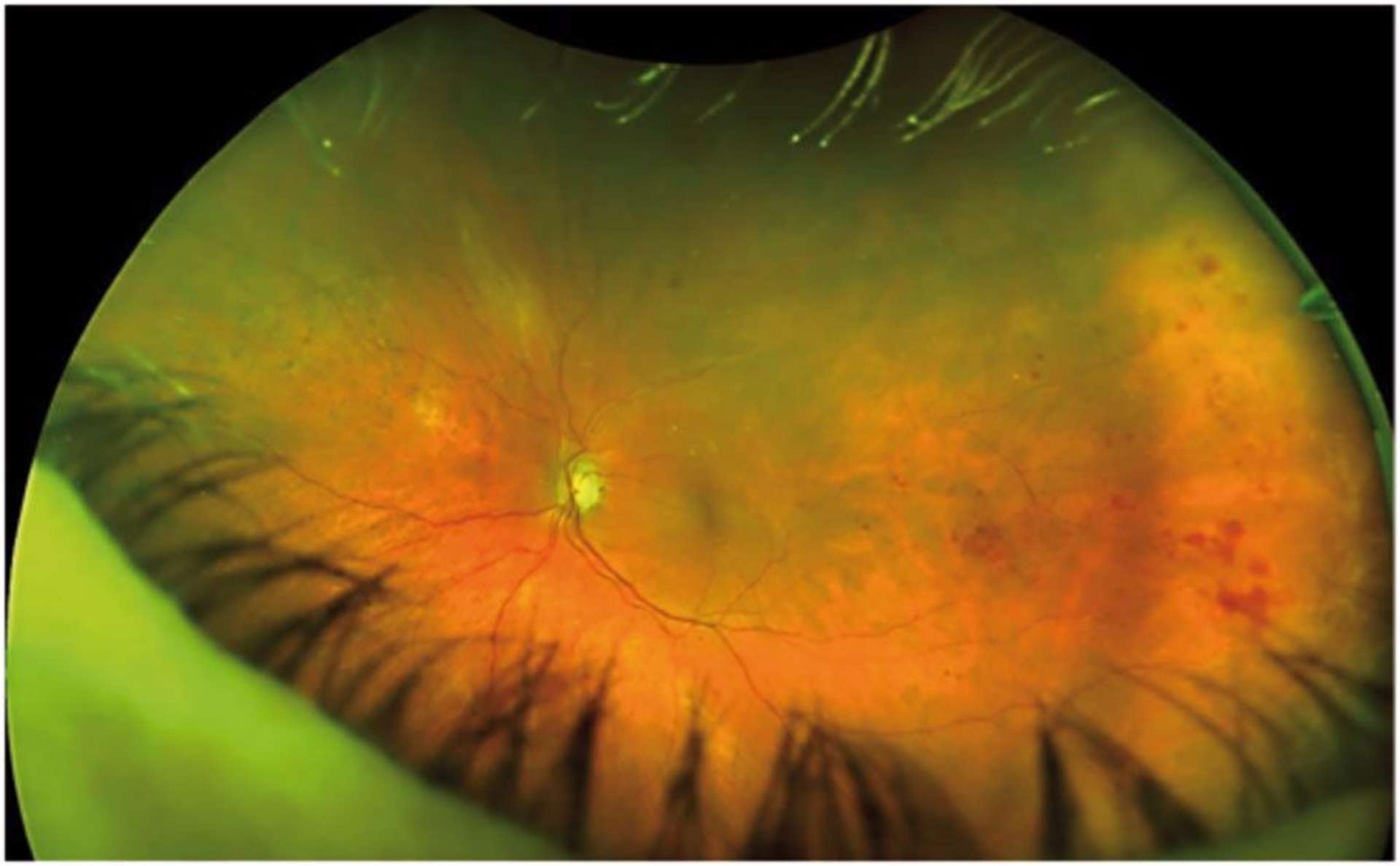 Figure 3. Rétinophotographie UGC (Optos) d’une oblitération de branche veineuse rétinienne temporale inférieure. Les hémorragies en tache sont prédominantes en moyenne et extrême périphérie rétinienne.
