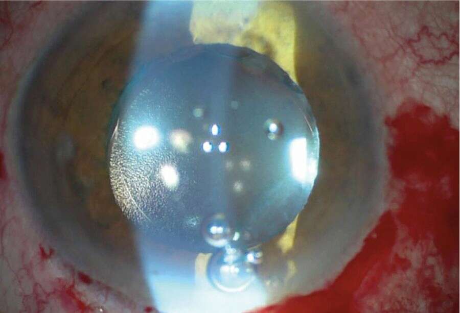 Figure 2. Aspect en lampe à fente peropératoire après explantation de l’implant de sulcus, montrant le blanchiment de l’implant.
