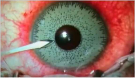 Figure 1. Explantation d’un implant d’iris coloré (image Pr Muraine).
