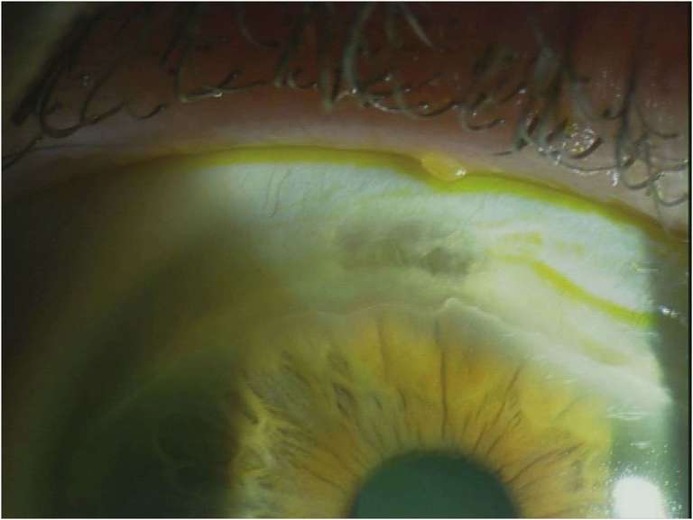 Figure 1. Photographie montrant l’amincissement supérieur périlimbique de l’œil droit.
