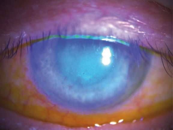 Figure 3. Kératite toxique centrale faisant suite à la prise d’AINS collyre en postopératoire de la cataracte.
