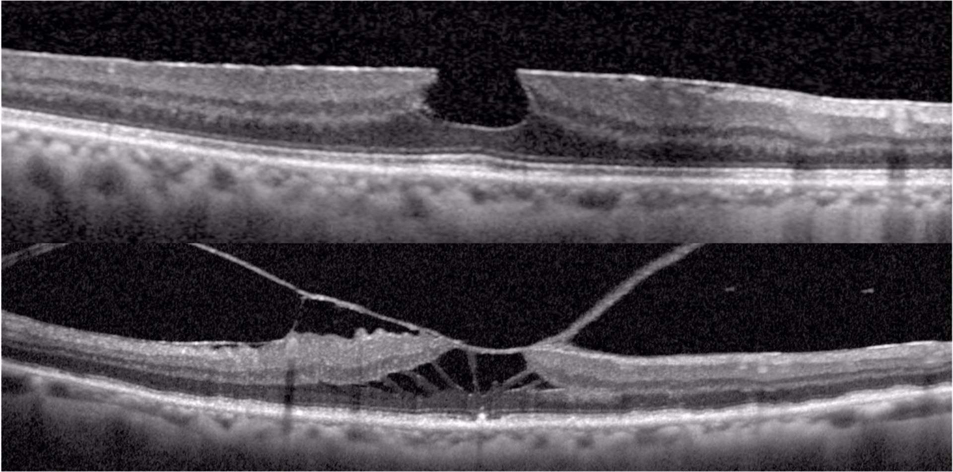 Figure 3. En haut. Pseudo-TM. MER avec verticalisation des bords de l’entonnoir fovéolaire sans perte de tissu rétinien fovéolaire. En bas. MER avec fovéoschisis et TVM. Schisis des couches des fibres de Henle et plis rétiniens.
