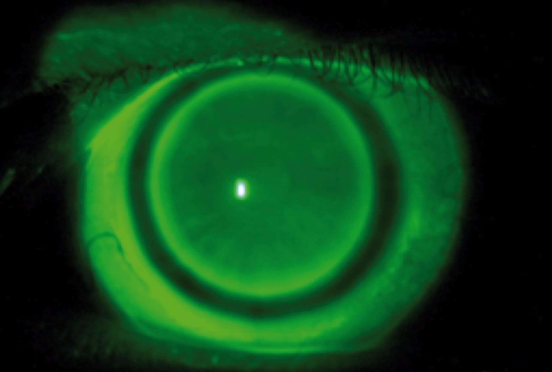 Figure 2. Lentille Duette MF parfaitement centrée.
