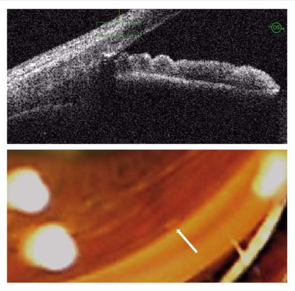 Figure 9. Coupes réalisées chez un patient ayant bénéficié de la pose d’un implant trabéculaire (iStent), qui apparaît hyperréflectif et s’accompagne d’un cône d’ombre postérieur. Noter la faible visibilité de l’implant lors de l’examen gonioscopique (flèche blanche).&nbsp;
