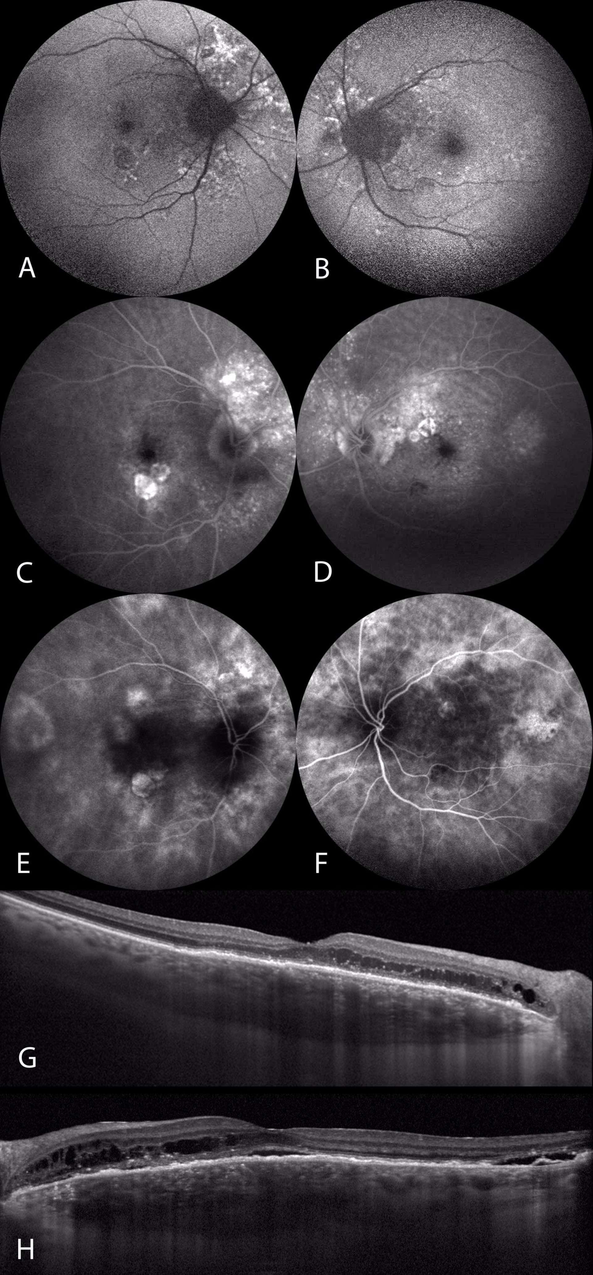 Figure 4. Imagerie multimodale d’un patient de 70 ans présentant un syndrome de pachychoroïde péripapillaire. Le cliché en autofluorescence bilatéral (A, B) met en évidence des altérations hyper-autofluorescentes de distribution péripapillaire correspondant à des zones hyperfluorescentes hétérogènes sur l’angiographie à la fluorescéine au temps tardif (C, D). Les plages d’hyperperméabilité vasculaire choroïdienne sur le cliché en ICG au temps intermédiaire (E, F) sont surtout localisées en supéropapillaire des 2 côtés. L’OCT EDI central met en évidence des kystes intrarétiniens de distribution interpapillomaculaire des 2 côtés (G, H), associés à un DSR seulement sur l’œil gauche (H). L’épaisseur choroïdienne fovéolaire est mesurée à plus de 500 microns des 2 côtés et la choroïde est particulièrement épaissie en nasal de la macula. 
