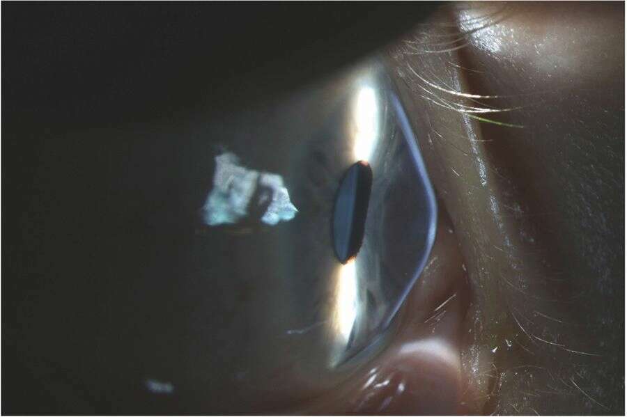 Figure 2. Photo de lampe à fente de profil de l’œil droit : importante déformation cornéenne.
