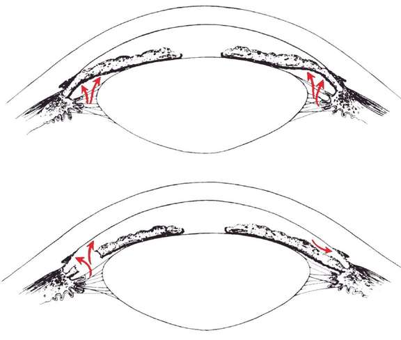 Mécanisme d’action de l’iridotomie laser en cas de blocage pupillaire. D’après Kolker AE
