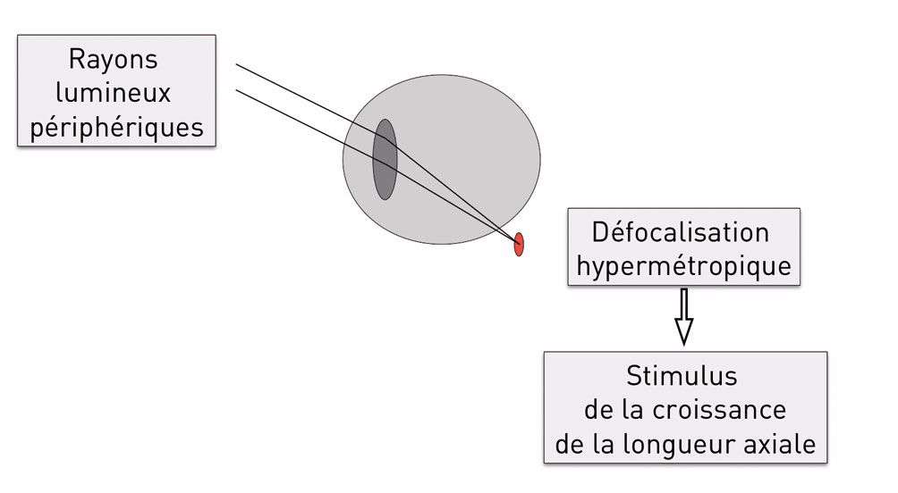 Figure 1. Lien entre la défocalisation localisée et la croissance de la longueur axiale du globe oculaire.
