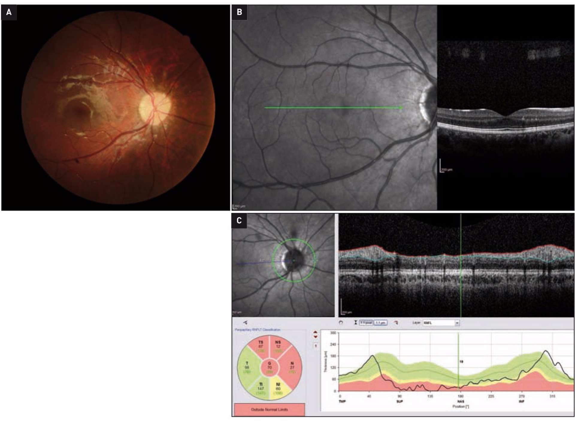 Figure 3. Rétinophotographie (A), OCT maculaire (B) et RNFL (C) après 4 semaines de traitement.

