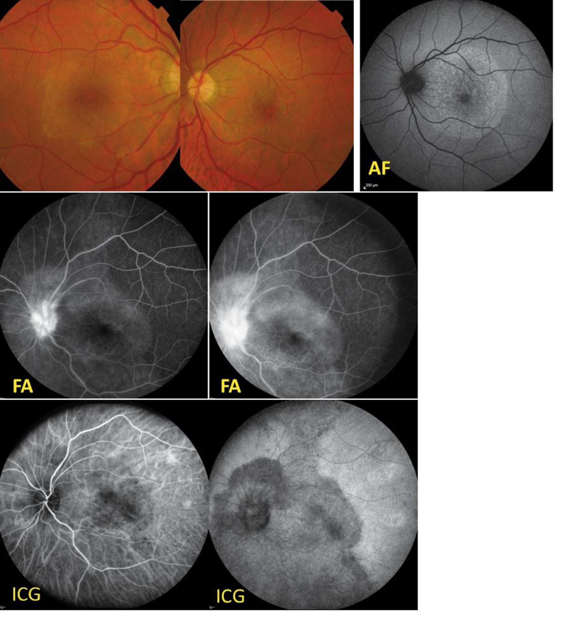 Figure 3. Choriorétinite postérieure placoïde syphilitique. Rétinophotos du fond d’œil de lésions planes, décolorées, en placard, blanc-jaunâtre de l’aire maculaire ; en autofluorescence (AF) : hyperautofluorescence des plaques ; en angiographie à la fluorescéine (FA) : visualisation d’une plage d’hyperfluorescence du pôle postérieur avec papillite ; en ICG : la lésion est hypofluorescente surtout aux temps tardifs.
