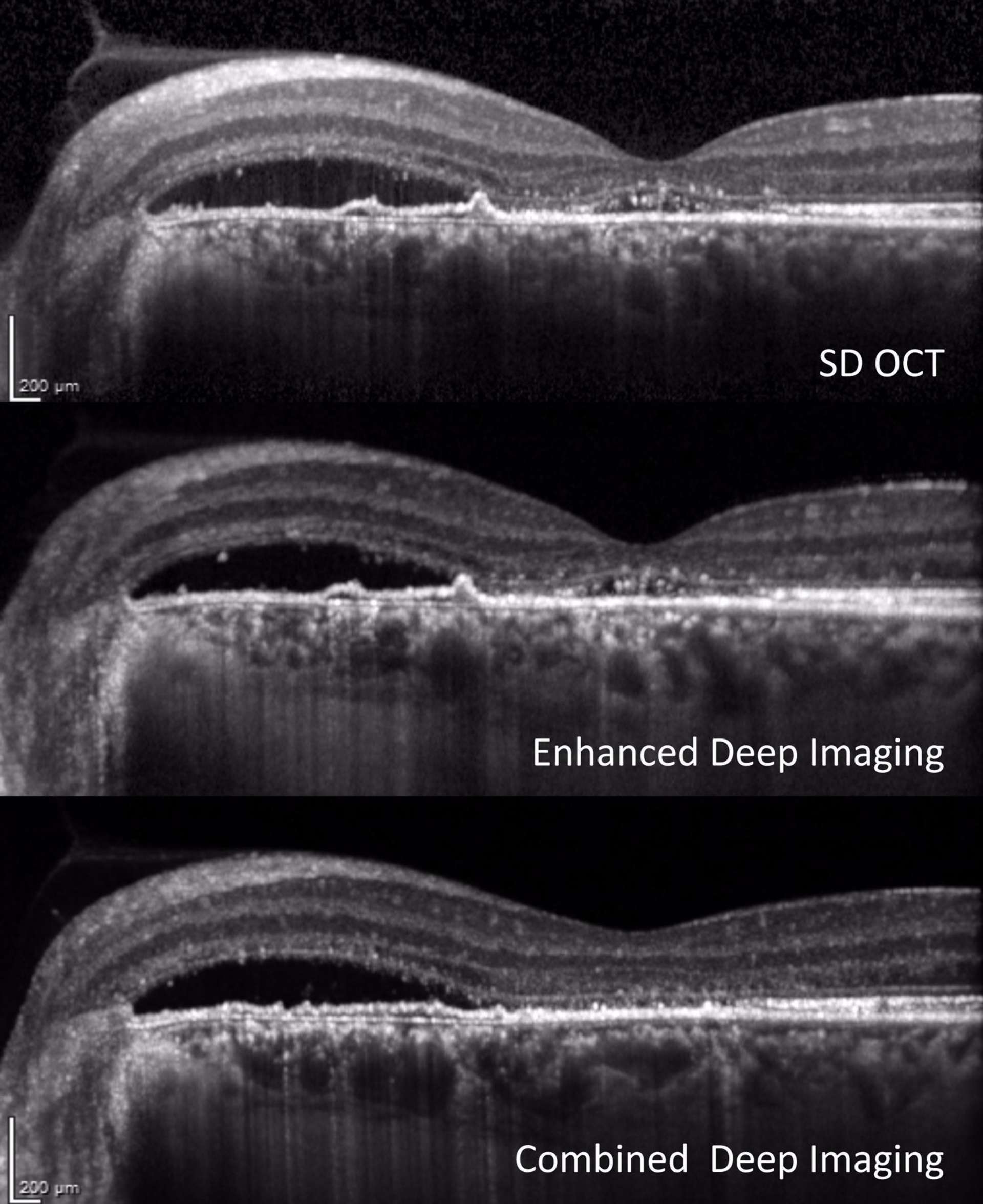 CDI/EDI OCT en mode SD-OCT, EDI et CDI d’une DMLA exsudative. En mode EDI, la choroïde est bien visualisée, aux dépens des structures rétiniennes  internes et du vitré postérieur. En mode CDI, il existe un compromis permettant à la fois la  visua lisation de la choroïde et de la rétine interne.
