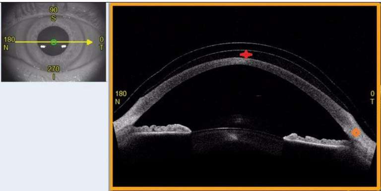 Figure 5. Coupe en OCT (Casia, Tomey) de l’œil gauche permettant d’évaluer l’espace liquidien (croix rouge) entre la lentille et la cornée, ainsi que le rapport entre la lentille et la zone d’appui sclérale (rond jaune).
