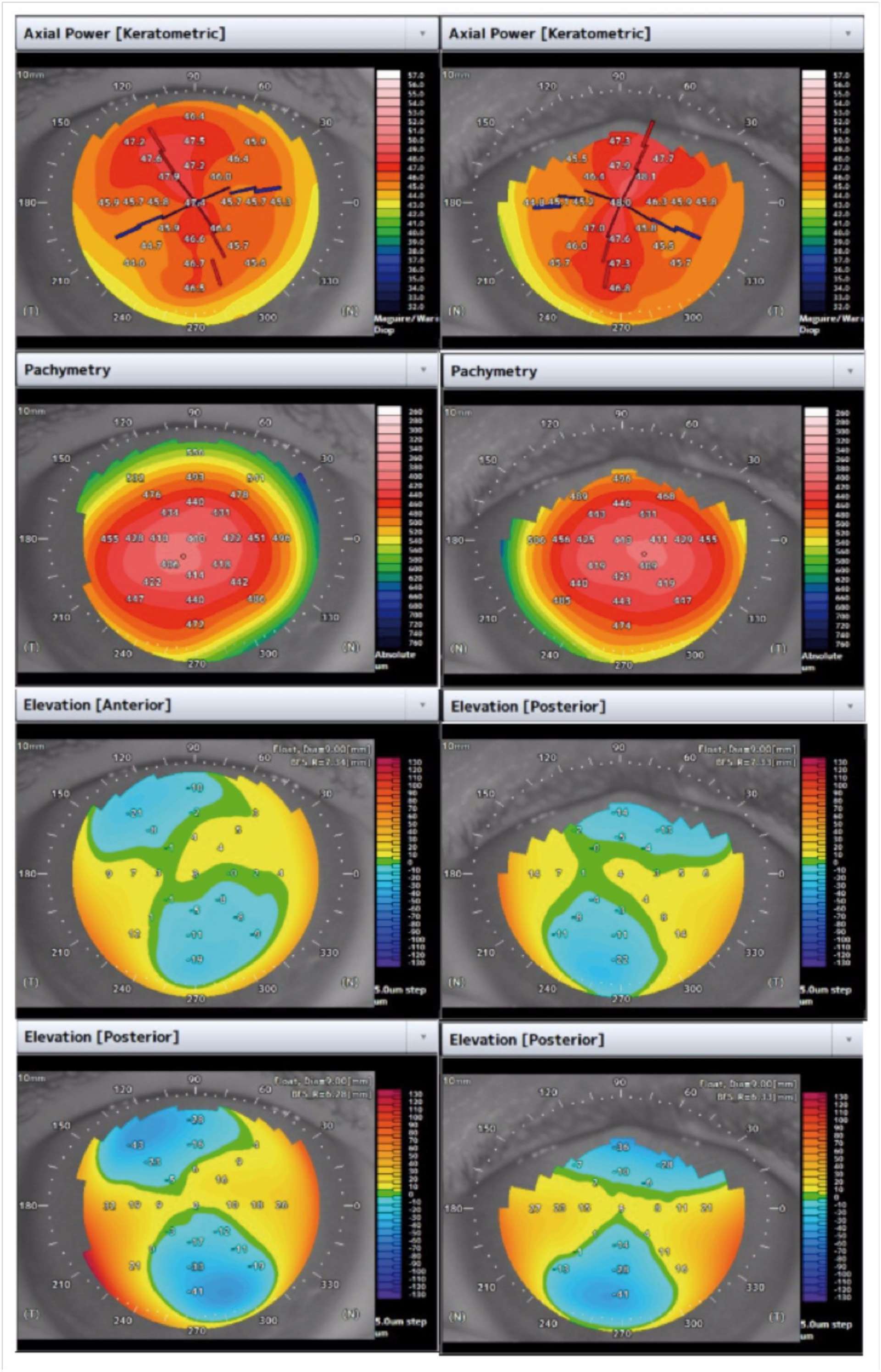 Figure 1. Topographie cornéenne de l’œil droit (photo de gauche) et de l’œil gauche (photo de droite) révèle  une kératométrie moyenne de 46,40 D, un cylindre de 1,70 D à 111°, et une pachymétrie globalement fine avec 403 µm au point le plus fin à l’œil droit. De façon similaire, les valeurs retrouvées à l’œil gauche sont de 46,80 D, 2,40 D, et 403 µm respectivement. 
