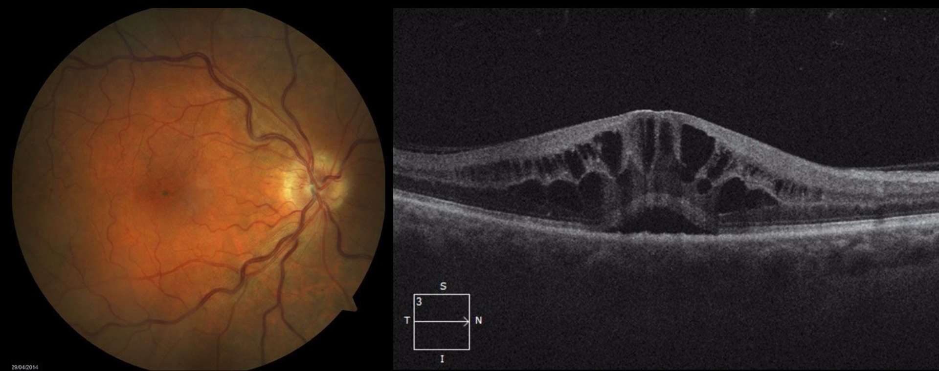 Figure 1. Aspects OCT d’un syndrome d’Irvine-Gass. On observe un épaississement rétinien maculaire et des logettes cystoïdes associés à un décollement séreux rétrofovéolaire limité. L’œdème prédomine au niveau des couches plexiforme externe et nucléaire interne.
