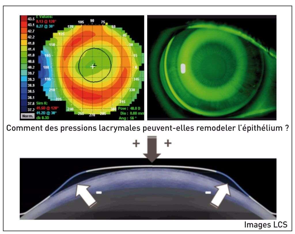 Astigmates presbytes et lentilles rigides cahiersophtalmologie