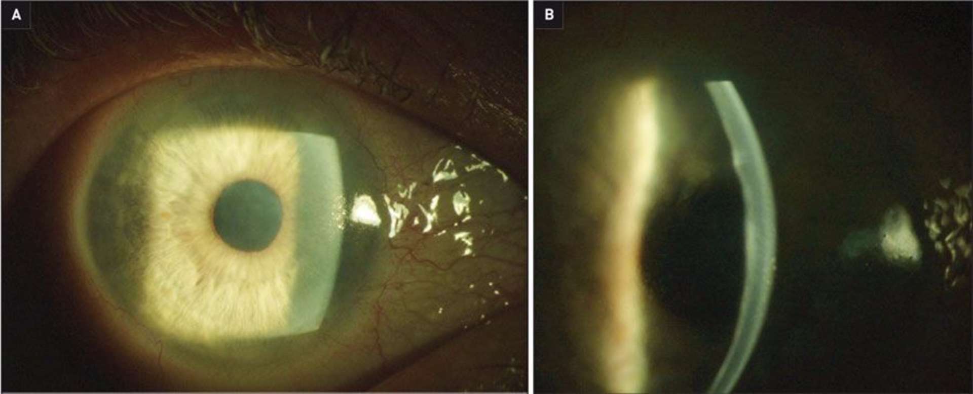 Figure 2. Examen à la lampe à fente de face (A) et en coupe (B) après 72h de dexaméthasone.
