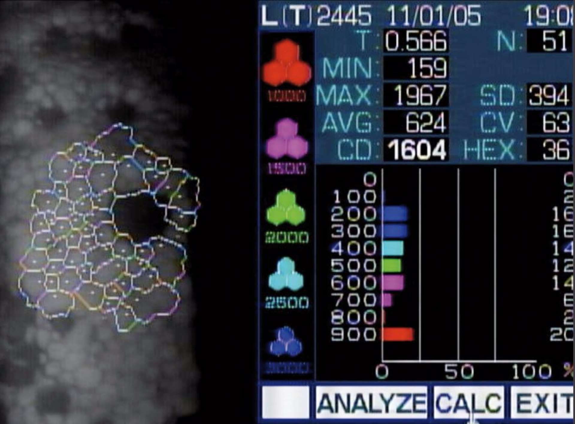 Le décompte du nombre de cellules endothéliales avec l’analyse de la forme et de la répartition des cellules apporte un élément indispensable dans le suivi des patients atteints de cornea guttata par exemple.
