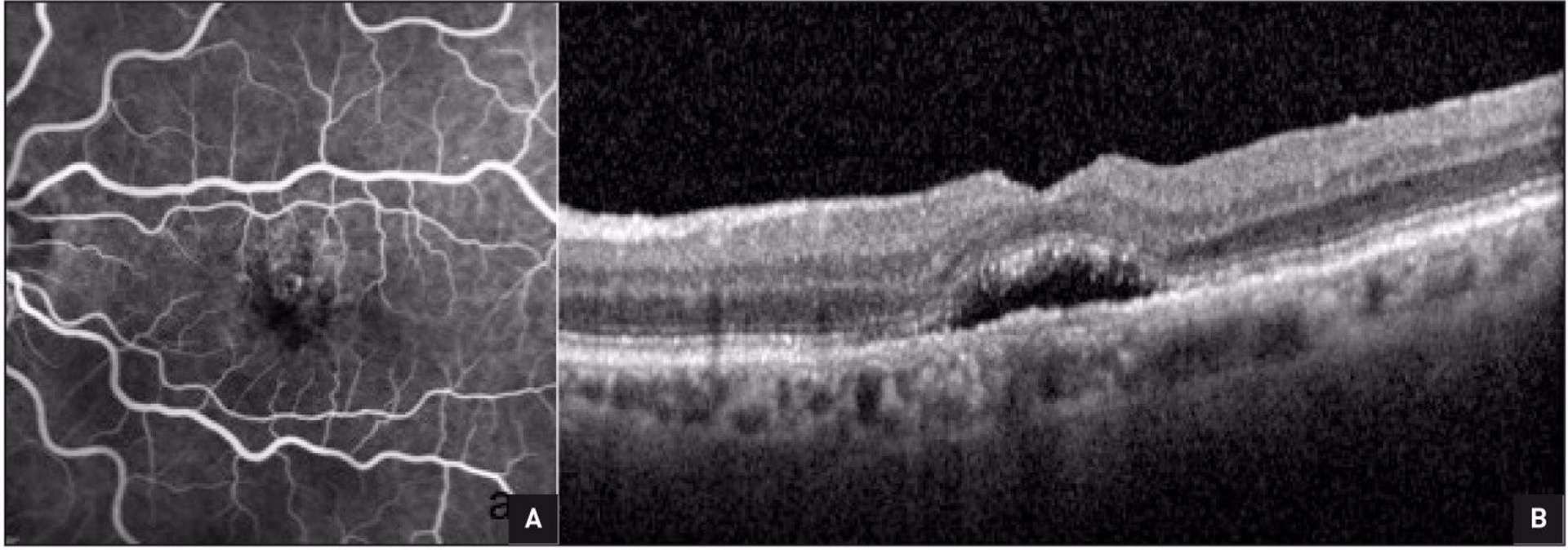 Figure 2. Exemple d’une dystrophie pseudo-vitelliforme acquise de l’adulte pouvant être prise à tort pour une DMLA. 
A. En angiographie à la fluorescéine, on retrouve une hyperfluorescence maculaire hétérogène tardive avec quelques diffusions. B. En OCT, on retrouve un DSR régulier, homogène, avec épaississement de la zone ellipsoïde. Il s’agit de matériel liquéfié et les IVT d’anti-VEGF n’ont pas d’effet sur ce matériel.
