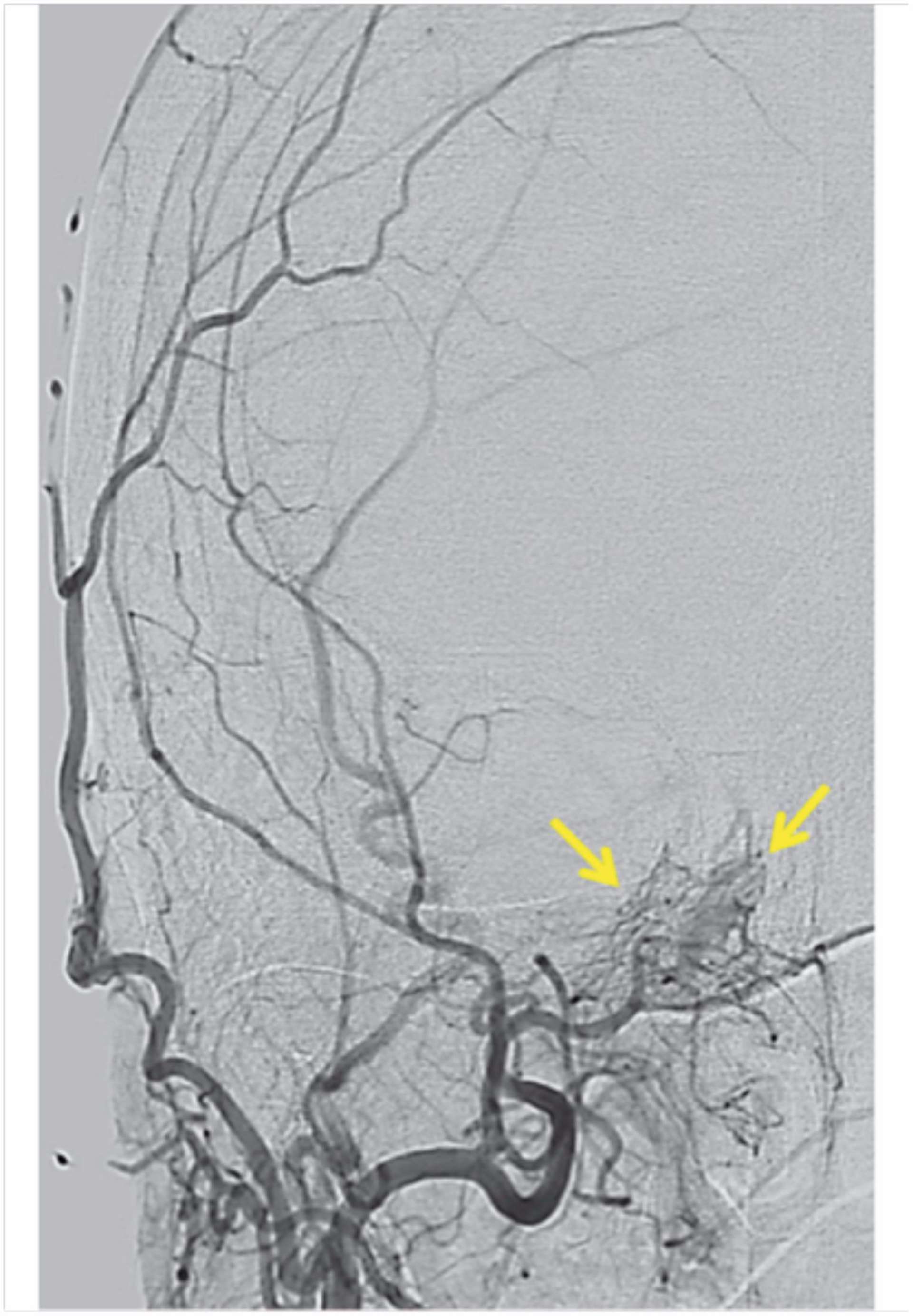 Figure 2. Artériographie cérébrale diagnostique montrant la fistule indirecte de type B selon la classification de Barrow.
