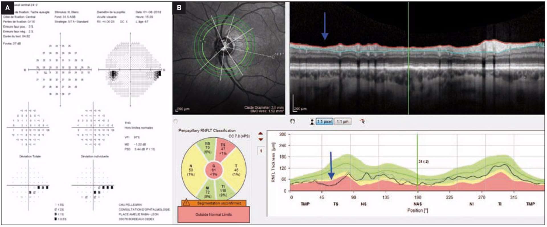 Figure 1. Patient atteint d’un glaucome primitif à angle ouvert avec ressaut nasal inférieur gauche sur le champ visuel automatisé (A) et déficit localisé en fibres nerveuses péripapillaires dans le secteur temporal supérieur (flèche bleue) en OCT Spectral-Domain (B).
