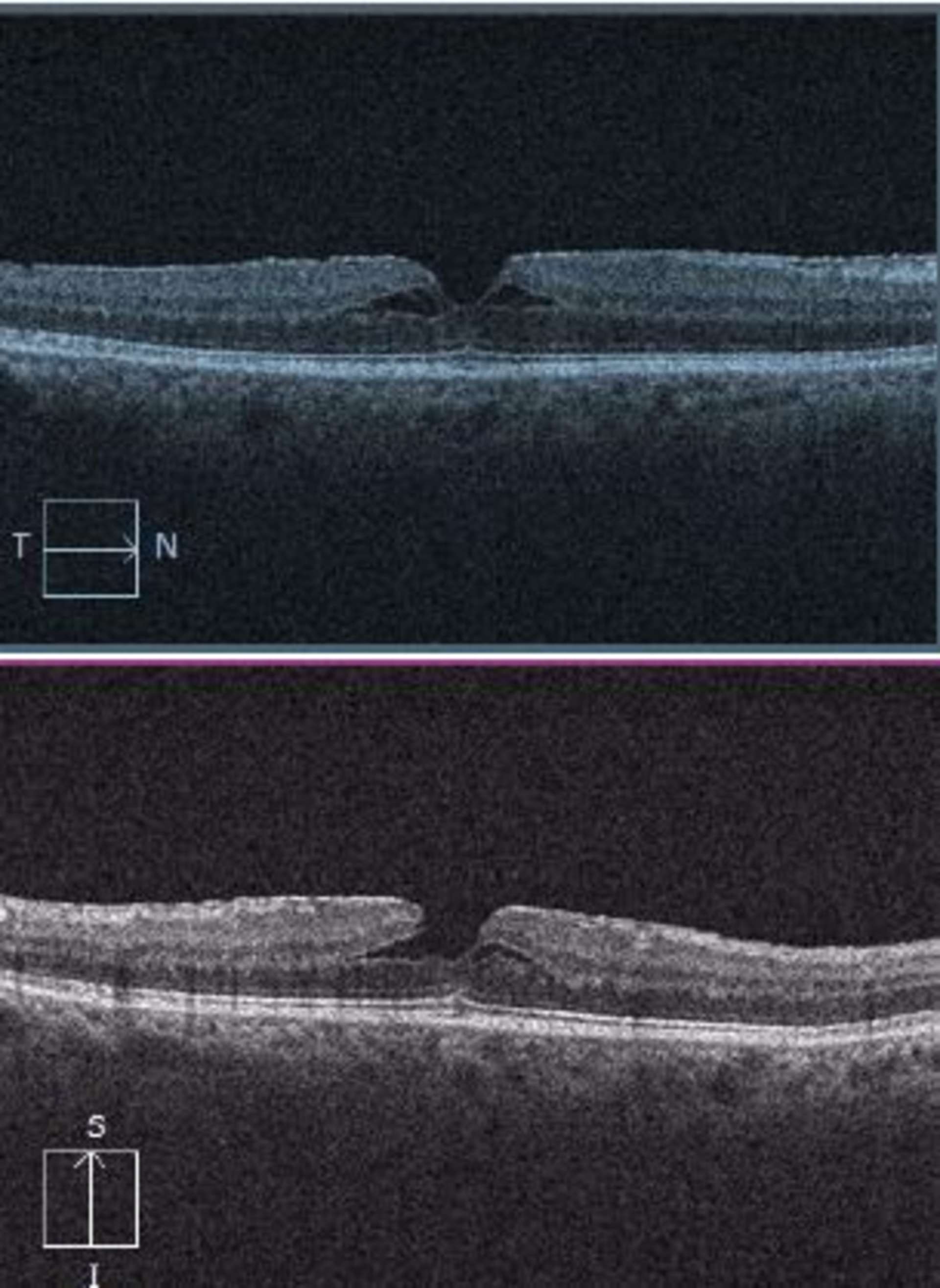 Découverte fortuite d’un pseudo-trou en faveur d’un Presbylasik plutôt que d’un Prelex.
