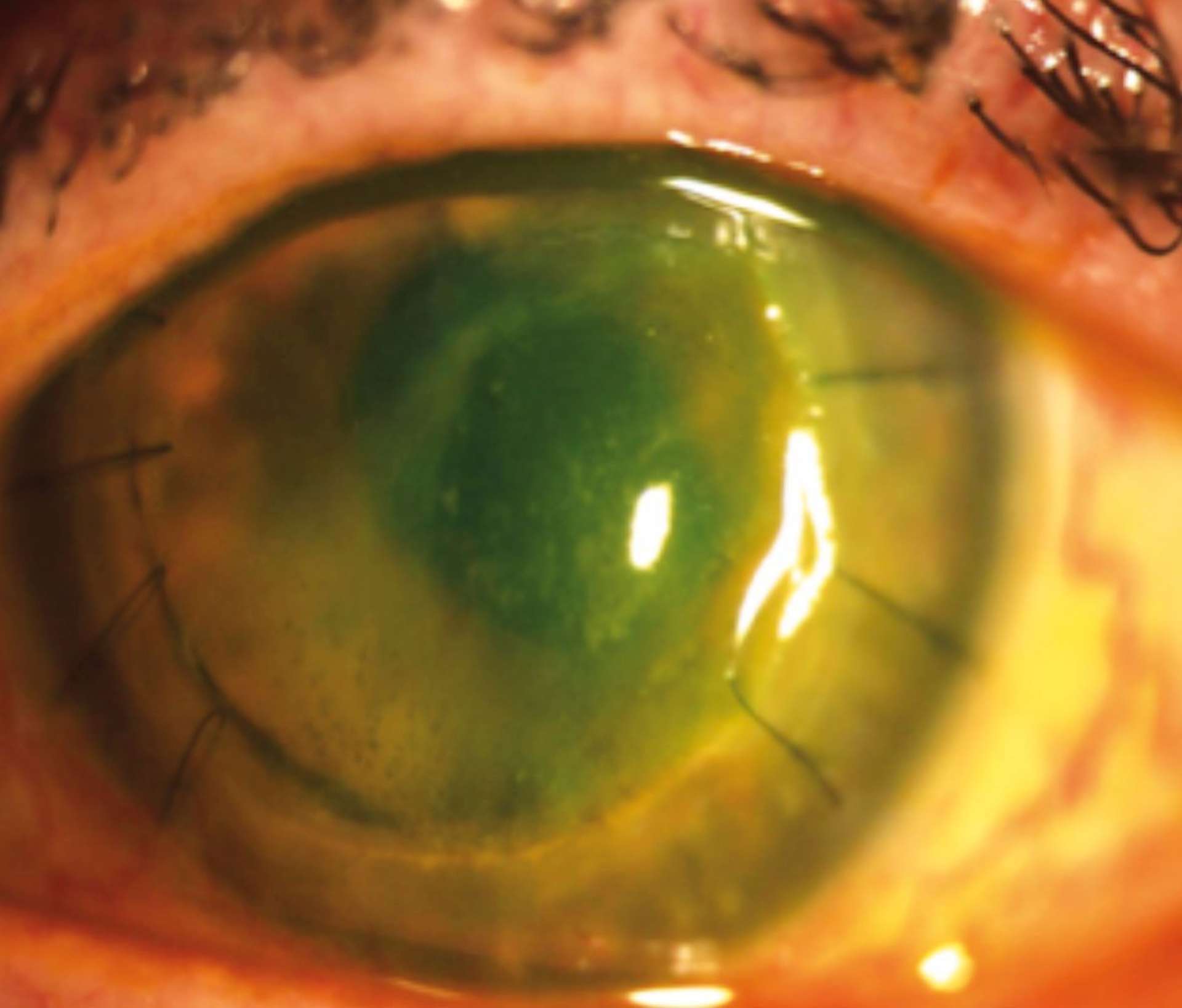 Figure 2. Rejet endothélial d’une kératoplastie transfixiante à 8 mois postopératoires.
